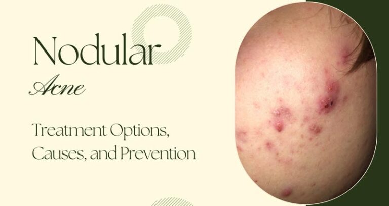 Nodular Acne