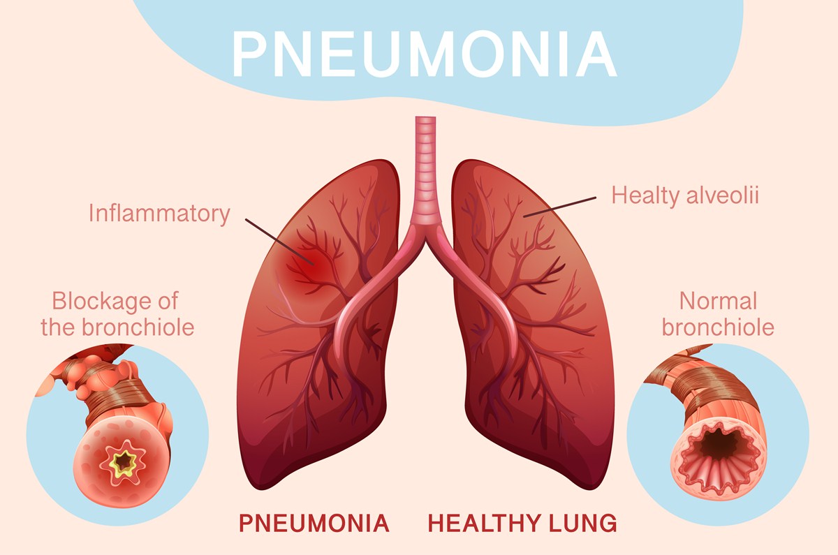  Home Remedies For Pneumonia