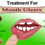 Home Remedies and Gel For Mouth Ulcers
