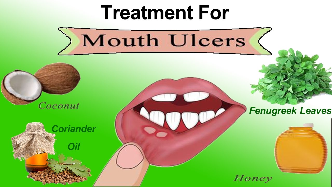  Home Remedies and Gel For Mouth Ulcers 