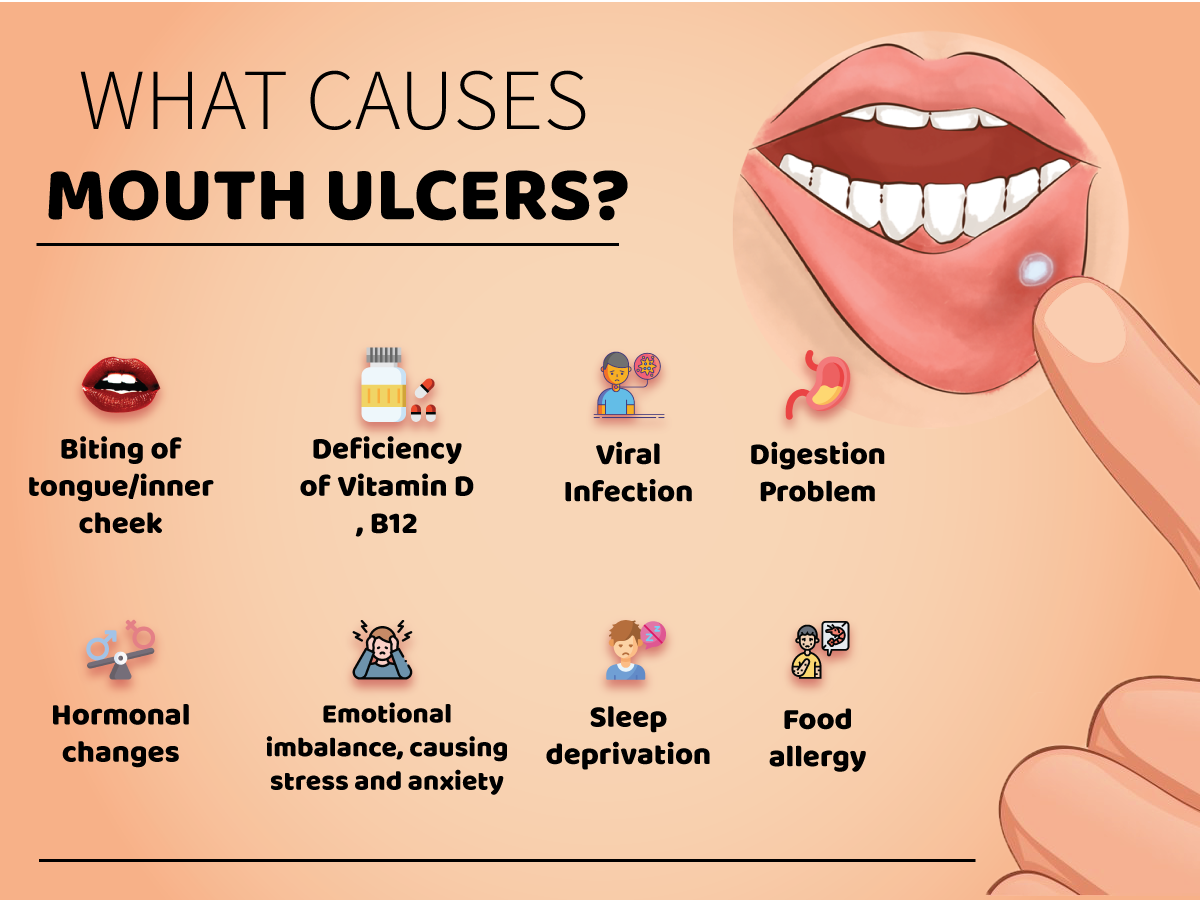 21 Best Home Remedies And Gel For Mouth Ulcers